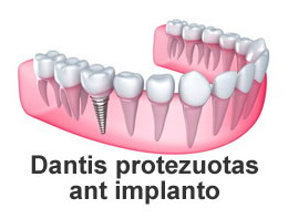 Protezavimas panaudojant dantų implantus