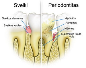 Parodontozės gydymas